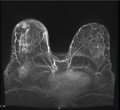 Magnetic resonance imaging (mri) of the breast — or breast mri — is a test used to detect breast cancer and other abnormalities in the breast. Triple Negative Breast Cancer What Crucial Information Can Imaging Add To The Diagnosis Treatment And Prognosis