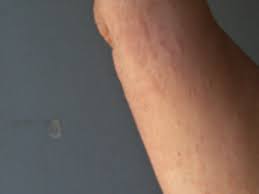 Skin reactions include rash and blistering. Under The Solano Sun Agriculture And Natural Resources Blogs