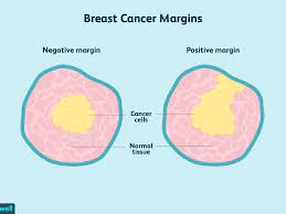 Breast cancer stages, idc type: Understanding Surgical Margins In Breast Cancer
