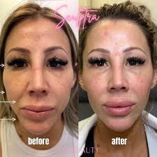 What is Sculptra? 👇🏻 As we age, our skin visibly shows signs of aging  like a lack of volume, fine lines and wrinkles. With Sculptra you are going  to see that lost