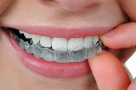 Dental braces (also known as braces, orthodontic cases, or cases) are devices used in orthodontics that align and straighten teeth and help position them with regard to a person's bite, while also aiming to improve dental health. How To Whiten Teeth With Braces Howstuffworks
