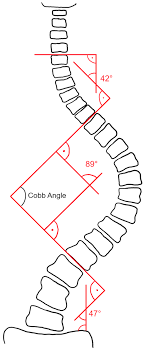 ما هي زاوية كوب في اعوجاج العمود الفقري؟