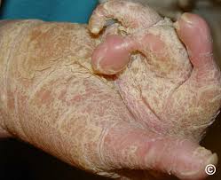 Image result for Ichthyosis