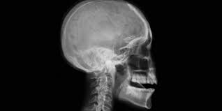 Image result for Skull XRay