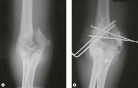 Image result for Lateral Condyle Fracture