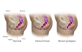 Image result for Rectal prolapse