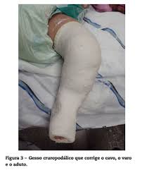 We did not find results for: Revista Brasileira De Ortopedia Treatment Of Congenital Clubfoot Using Ponseti Method