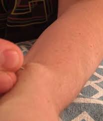 New boils are usually associated with some sort of friction. Video Shows Man Popping A Large Ganglion Cyst On His Arm With A Pin Daily Mail Online