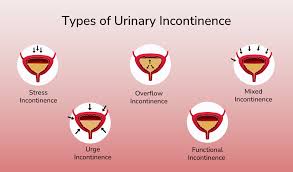 Image result for Urinary Incontinence