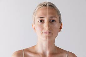 RF Microneedling Treatment in Calgary