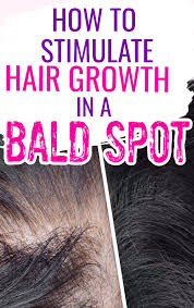 An extreme hair loss condition… alopecia is hair loss from the scalp or anywhere else on your face or body, which occurs in men, women, and children and it can occur at any age (depending on the type of alopecia). Grow Gorgeous Hair Growth Serum Review Stimulate Growth In A Bald Spot Grow Hair Back Regrow Lost Hair Hair Growth Treatment