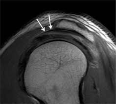 The conjoint tendon is a sheath of connective tissue that attaches the transversus abdominis, the deepest of the four abdominal muscles, to the pelvis. Shoulder Anatomy And Normal Variants
