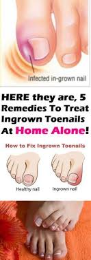 Check spelling or type a new query. 22 Ingrown Nails Nail Health Ideas Ingrown Nail Ingrown Toe Nail Toe Nails