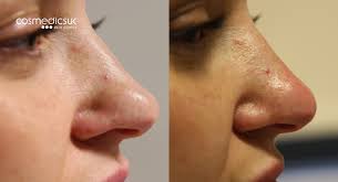 The fever should settle in less than a week, although the cough may linger. Non Surgical Nose Job Rhinoplasty Cosmedics Skin Clinics