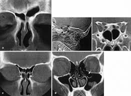 Cystic brosis (cf) is the most lethal genetic disorder in the caucasian population. A Coronal Ct Scan In A Cystic Fibrosis Cf Patient With Two Confirmed Download Scientific Diagram