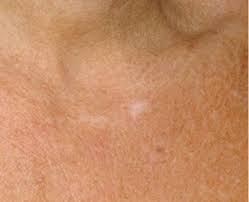 Today, 1 january 2019, i saw some improvement of upper legs, but in lower legs the situation is still sad. Hypopigmentation Best Clinic Sydney For Dermal Fillers