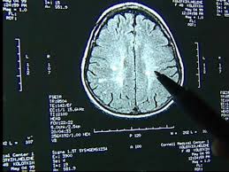 Duyurular cte haberler kurum haberleri basında cte taziye. Former Nfl Player Confirmed As 1st Diagnosis Of Cte In Living Patient Abc News