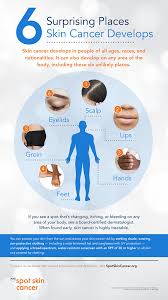May is skin cancer awareness month and may 4 is melanoma monday®. How To Check Your Nails For Melanoma Birminghamparent Com