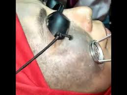 Sebagian tanda lahir timbul karena adanya kelainan pembuluh darah, sementara sebagian lainnya timbul karena penimbunan pigmen. Laser Buang Tanda Lahir Youtube