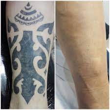 Check spelling or type a new query. Lasser Tattoo Valencia Eliminacion De Tatuajes Valencia Quitar O Eliminar Tatuajes Valencia