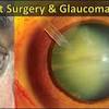 Glaucoma is a group of eye diseases that can cause vision loss and blindness by damaging a nerve in the back of your eye called the optic nerve. 1