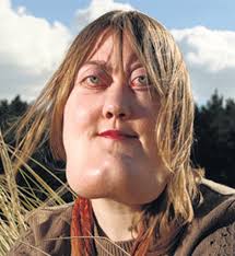 A woman named Victoria Wright was born with a rare genetic condition called  cherubism. Doctors said her head was as heavy as a bowling ball.