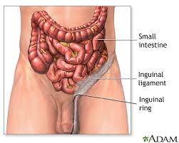 Image result for Inguinal hernia man