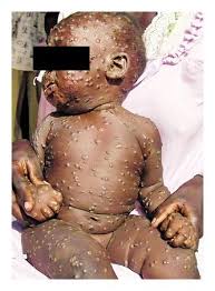 Monkeypox belongs to the same family of viruses as smallpox. Discovery Of Monkeypox In Sudan Nejm
