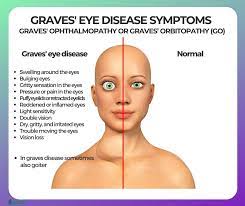 Sridama v & degroot lj. Graves Disease Symptoms Causes Risk Groups Conventional Treatment Diet And Home Remedies Ecosh Life