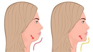 A double chin is subcutaneous fat deposition found under the lower jaw and around the neck which makes the tissues to sag down creating an appearance of though there are many methods like cosmetic surgeries and liposuction to remove the problem, it is possible to get rid of double chin by. 7 Exercises That Remove Double Chin