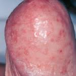 Manchas Y Puntos Rojos En El Pene Causas Y Tratamiento