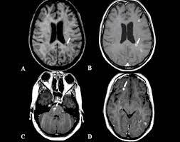 A ressonância magnética foi desenvolvida a partir dos anos 30, no entanto, somente na década de 80 passou a ser usada em hospitais. Amigos Multiplos Pela Esclerose Melhor Compreensao Da Remielinizacao Oferece