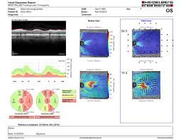Jul 28, 2020 · glaucoma is a group of eye diseases that can cause vision loss and blindness by damaging a nerve in the back of your eye called the optic nerve. Heidelberg Engineering Introduces The Gmpe Hood Glaucoma Report For Spectralis Oct Heidelberg Engineering Inc
