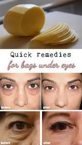 Tuesday S Tip Natural Solutions To Get Rid Of Under Eye Bags Dark Circles Or Eye Puffiness Pot Pour Puffy Eyes Remedy Quick Remedies Beauty Hacks