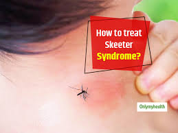More images for skeeter syndrome » Skeeter Syndrome Home Remedies And Tips To Prevent This Allergic Reaction