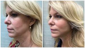 The cost of the chin liposuction procedures will depend on the size of the chosen area and the time required to perform the procedure. How To Get Rid Of A Double Chin 19 Facts About Chin Facial Liposuction