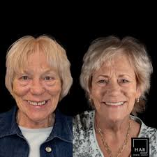 This patient first came to us after watching her husband transform his  smile in our office. His previous snaps, done elsewhere, had failed, and  once he received his repair and new implants