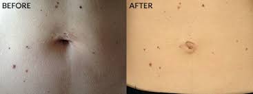 Gastric sleeve procedure, also known as sleeve gastrectomy, involves surgical removal of part of a stomach. Scars From Gastric Sleeve Surgery How Your Stomach Will Look Bariatric Surgery Source