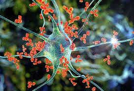 Guillain Barre Syndrome Gbs Recovery Time Treatment Symptoms