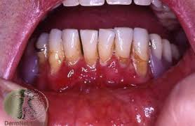 Image result for gingivitis image