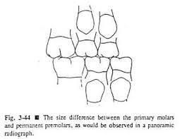 Space Relationships In Replacement Of Canines And Primary