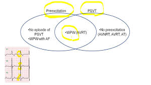 We did not find results for: Wpw ì™€ Psvt ì˜ ì •ì˜ Youtube