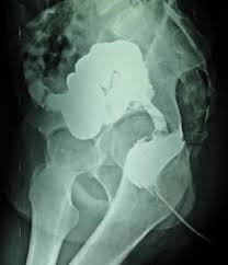 Babies and cancer q&a by erin breese, m.d. Adenocarcinoma Of The Colon In Children Case Series And Mini Review Of The Literature Sciencedirect