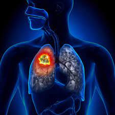 In fact, 30 to 40 percent of lung cancer diagnoses come only after the lung cancer has spread, either to the other lung or further throughout the body. What Are Some Of The First Signs Of Lung Cancer Lung Cancer Pintas Mullins Law Firm