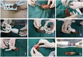 How do you care for an infant circumcision? Scielo Brazil Adult Male Circumcision With A Circular Stapler Versus Conventional Circumcision A Prospective Randomized Clinical Trial Adult Male Circumcision With A Circular Stapler Versus Conventional Circumcision A Prospective Randomized
