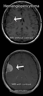 Intracranial Hemangiopericytoma Radiology Imaging Radiology Medical Imaging