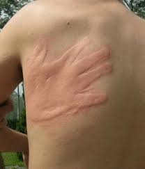 Image result for Dermatographism