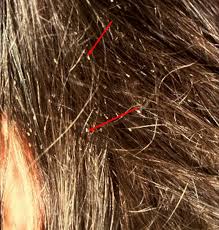 Head Lice Nits Pictures And How To Get Rid Of Head Louse Nits Head Lice Nits Lice Nits Head Lice Remedy