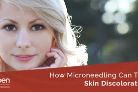 Microneedling for Skin Pigmentation