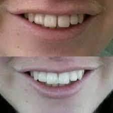Some are simple and fast, others will take months. 12 Dental Bonding Ideas Dental Bonding Dental Dental Care